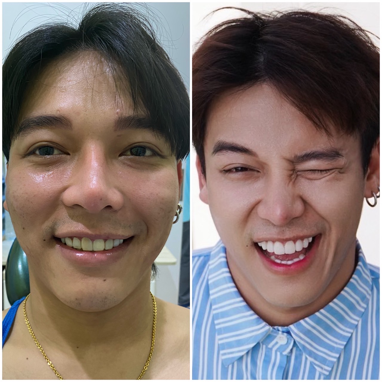 รีวิวคนไข้ทันตกรรมวีเนียร์น้องเบนโตะ